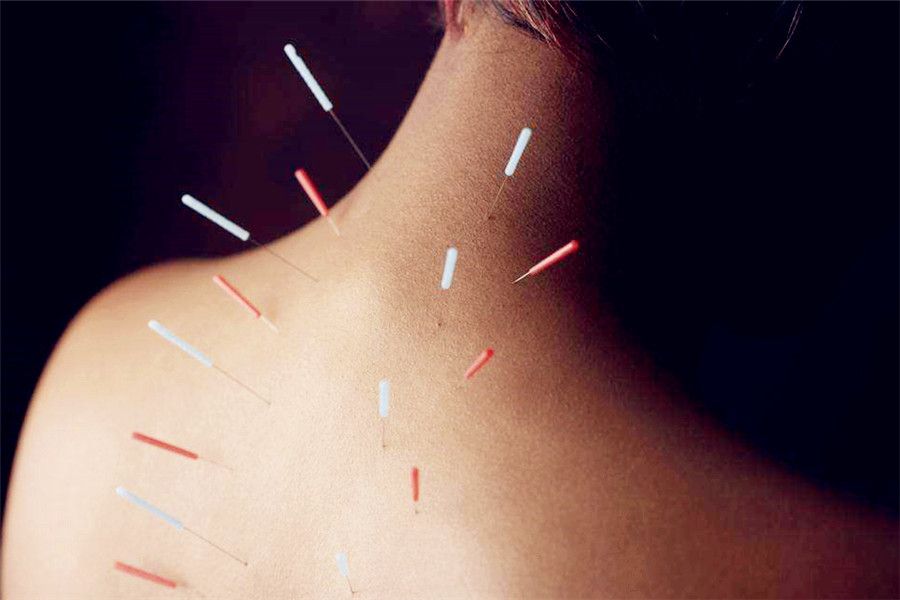 Chinese Acupuncture and Moxibustion - What is acupuncture